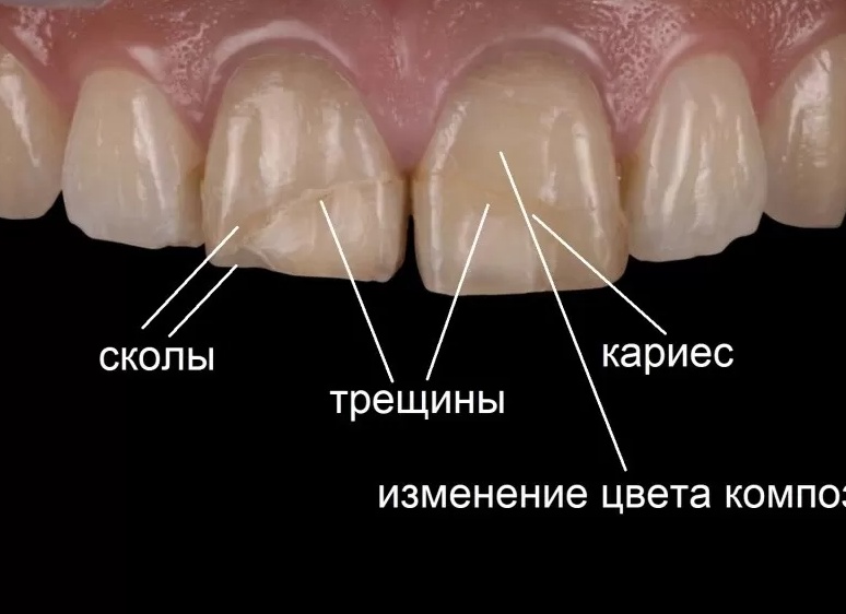 Как я сломала оба передних зуба на Филиппинах